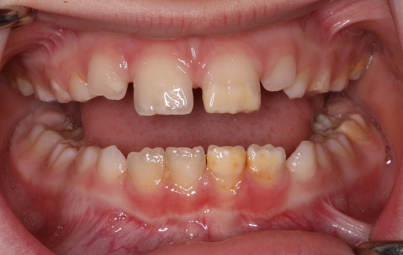 Chalky teeth example 1 - Enamel hypomineralisation