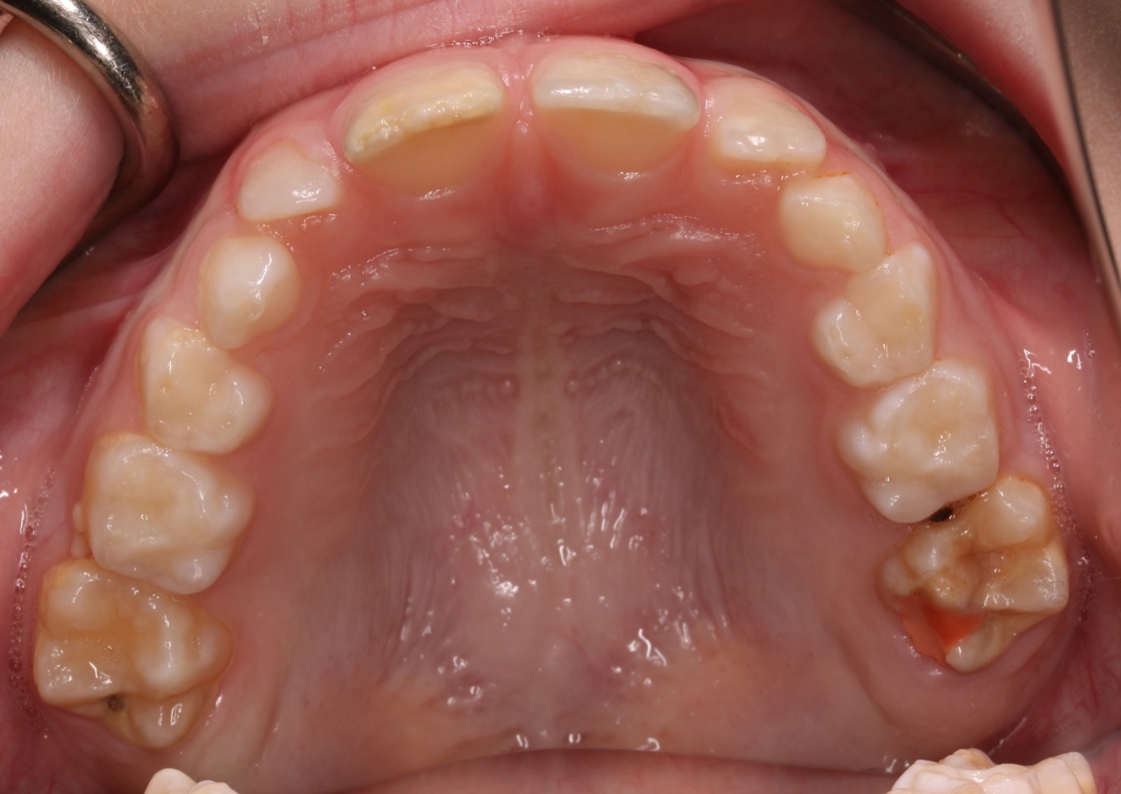 Chalky teeth example 2 - Molar incisor hypomineralisation
