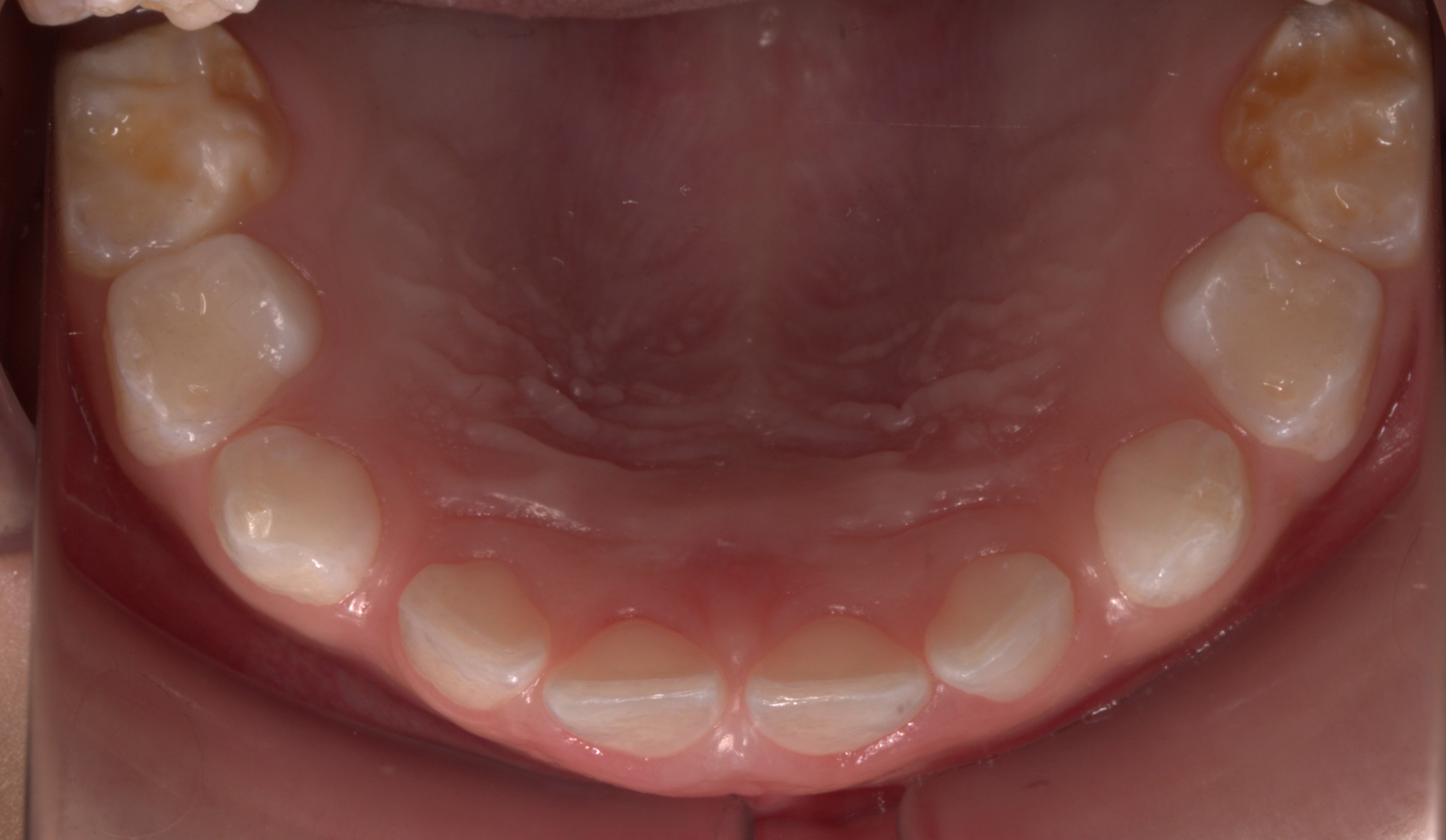 Chalky teeth treatment - Early intervention for enamel hypomineralisation